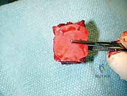 صورة طبية: مراجعة مفصل الكاحل الصناعي (Agility) وعلاج كسور الكعب: دليل شامل للمرضى