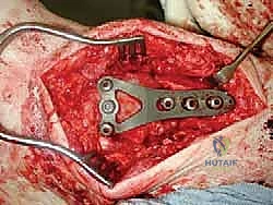 صورة توضيحية لـ مراجعة مفصل الكاحل الصناعي (Agility) وعلاج كسور الكعب: دليل شامل للمرضى