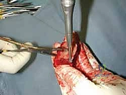 صورة طبية: مراجعة مفصل الكاحل الصناعي (Agility) وعلاج كسور الكعب: دليل شامل للمرضى