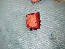 صورة طبية: مراجعة مفصل الكاحل الصناعي (Agility) وعلاج كسور الكعب: دليل شامل للمرضى