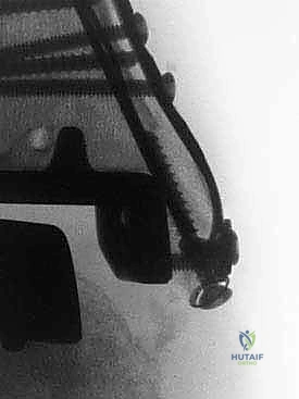 صورة طبية: مراجعة مفصل الكاحل الصناعي (Agility) وعلاج كسور الكعب: دليل شامل للمرضى