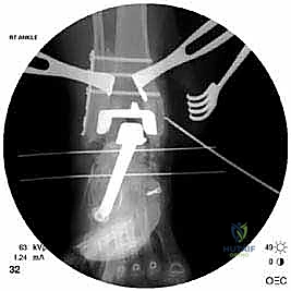 صورة توضيحية لـ مراجعة مفصل الكاحل الصناعي (Agility) وعلاج كسور الكعب: دليل شامل للمرضى