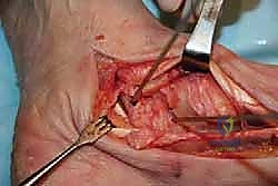 صورة توضيحية لـ مراجعة مفصل الكاحل الصناعي (Agility) وعلاج كسور الكعب: دليل شامل للمرضى