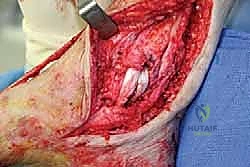 صورة طبية: مراجعة مفصل الكاحل الصناعي (Agility) وعلاج كسور الكعب: دليل شامل للمرضى