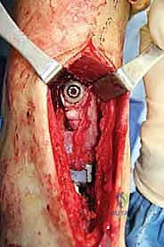 صورة طبية: مراجعة مفصل الكاحل الصناعي (Agility) وعلاج كسور الكعب: دليل شامل للمرضى