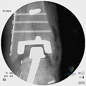 أدوات التثبيت الجراحي