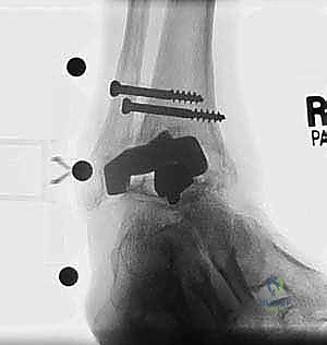 صورة طبية: مراجعة مفصل الكاحل الصناعي (Agility) وعلاج كسور الكعب: دليل شامل للمرضى