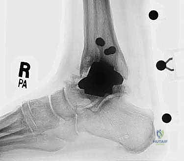 صورة طبية: مراجعة مفصل الكاحل الصناعي (Agility) وعلاج كسور الكعب: دليل شامل للمرضى