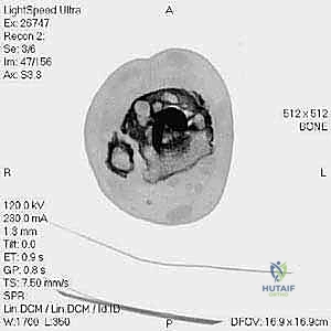 صورة توضيحية لـ مراجعة مفصل الكاحل الصناعي