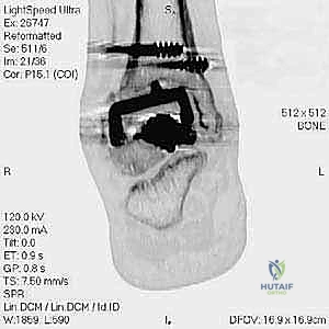 خيارات المفاصل الصناعية الجديدة