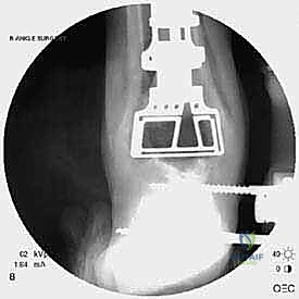 صورة طبية: مراجعة مفصل الكاحل الصناعي (Agility) وعلاج كسور الكعب: دليل شامل للمرضى