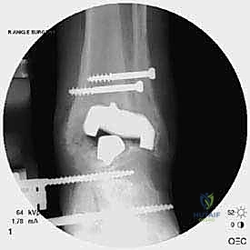 صورة لكسر الكعب الداخلي