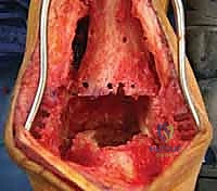 صورة طبية: مراجعة مفصل الكاحل الصناعي (Agility) وعلاج كسور الكعب: دليل شامل للمرضى