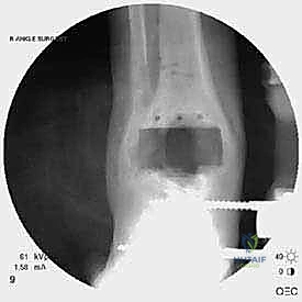 فتح الشق الجراحي