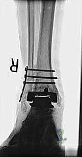تثبيت كسر الكعب بصفيحة معدنية