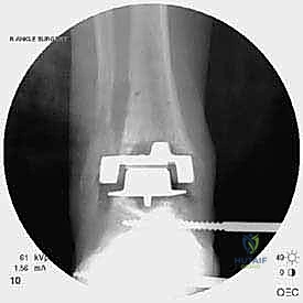 صورة توضيحية لـ مراجعة مفصل الكاحل الصناعي (Agility) وعلاج كسور الكعب: دليل شامل للمرضى