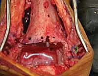 صورة طبية: مراجعة مفصل الكاحل الصناعي (Agility) وعلاج كسور الكعب: دليل شامل للمرضى