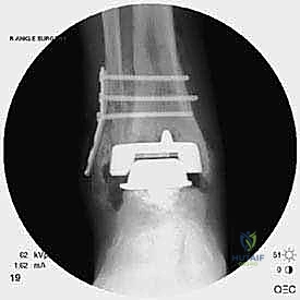 تنظيف التجويف العظمي