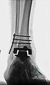 صورة أشعة سينية توضح التخلخل