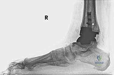 صورة لكسر في الكعب مصاحب للمفصل