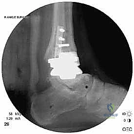 صورة طبية: مراجعة مفصل الكاحل الصناعي (Agility) وعلاج كسور الكعب: دليل شامل للمرضى