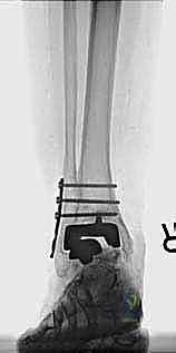 صورة طبية: مراجعة مفصل الكاحل الصناعي (Agility) وعلاج كسور الكعب: دليل شامل للمرضى