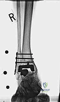 صورة طبية: مراجعة مفصل الكاحل الصناعي (Agility) وعلاج كسور الكعب: دليل شامل للمرضى