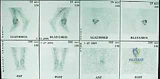 صورة طبية: مراجعة مفصل الكاحل الصناعي (Agility) وعلاج كسور الكعب: دليل شامل للمرضى