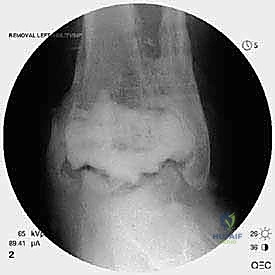 صورة طبية: مراجعة مفصل الكاحل الصناعي (Agility) وعلاج كسور الكعب: دليل شامل للمرضى