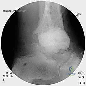 صورة طبية: مراجعة مفصل الكاحل الصناعي (Agility) وعلاج كسور الكعب: دليل شامل للمرضى