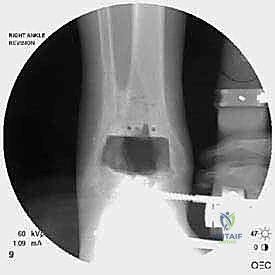 Revision Agility Total Ankle Arthroplasty: An Intraoperative Masterclass on Malleolar Fracture Management