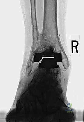 FIG 15  This patient seen in Tech Fig 8 decided to forgo revision surgery and continued to bear full weight on the cement spacer  A
