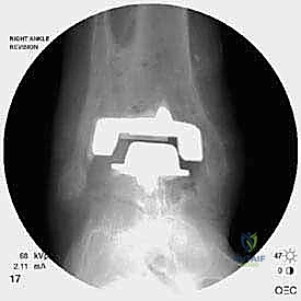صورة طبية: مراجعة مفصل الكاحل الصناعي (Agility) وعلاج كسور الكعب: دليل شامل للمرضى