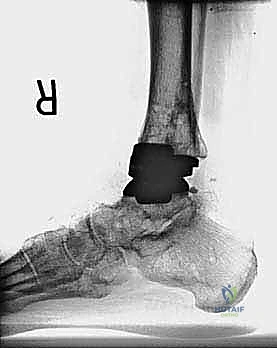 وضع الجبيرة النهائية