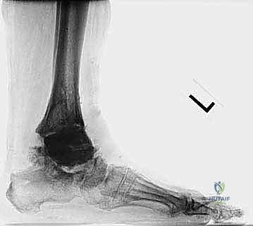 FIG 15  This patient seen in Tech Fig 8 decided to forgo revision surgery and continued to bear full weight on the cement spacer  A