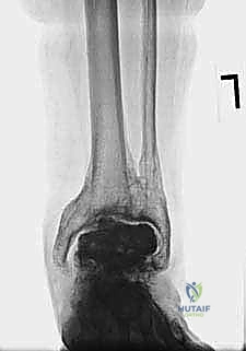 FIG 15  This patient seen in Tech Fig 8 decided to forgo revision surgery and continued to bear full weight on the cement spacer  A