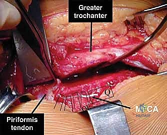 Surgical Dislocation of the Hip: A Masterclass in Femoroacetabular Impingement Correction