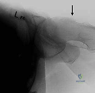 استخدام الرنين المغناطيسي لتشخيص تمزق الشفا