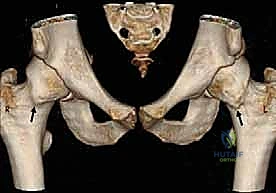 مقارنة بين الجراحات المختلفة للورك