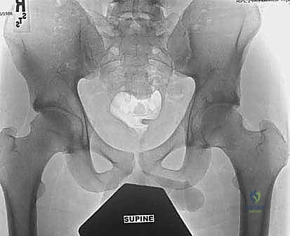 تقييم صور الأشعة المتقدمة للورك