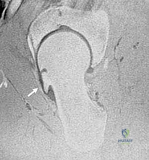 الشق الجراحي والوصول للمفصل