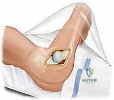 فتح كبسولة المفصل بشكل احترافي