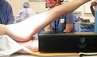 خلع مفصل الفخذ الجراحي مع الدكتور محمد هطيف