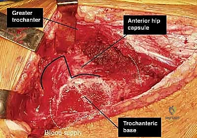خياطة وتثبيت الشفا الحقي