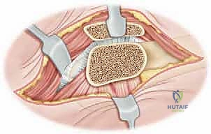 إزالة النتوء العظمي (الكامة)