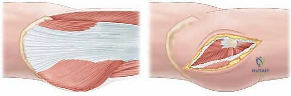 تشذيب حافة التجويف الحقي