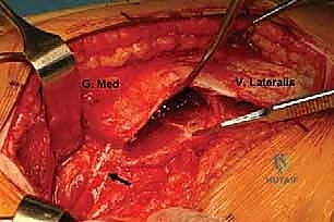 صورة للرؤية الشاملة بعد الخلع
