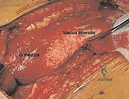 العلاج الطبيعي في مراحله الأولى
