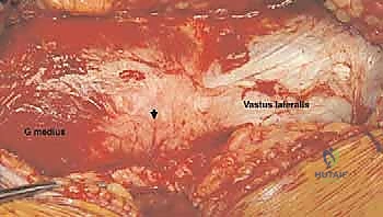 رد المفصل واختبار الحركة