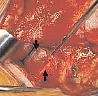 الأستاذ الدكتور محمد هطيف أثناء الجراحة